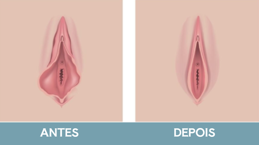 Ninfoplastia